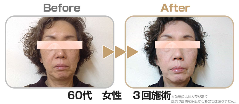60代女性3回施術